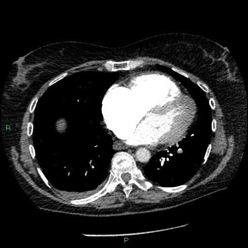 File:Bilateral pulmonary emboli (Radiopaedia 32700-33669 Axial C+ CTPA 73).jpg