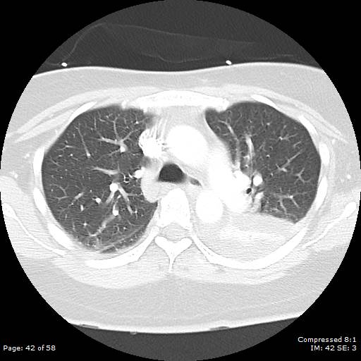 Bilateral pulmonary emboli with Hampton hump sign (Radiopaedia 54070-60246 Axial lung window 42).jpg