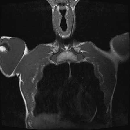 File:Bilateral spinoglenoid notch ganglion cysts (Radiopaedia 29577-30082 Coronal T1 2).jpg