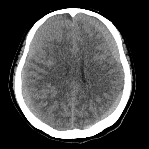 Bilateral subacute subdural hematoma (Radiopaedia 69240-79018 Axial non-contrast 31).jpg