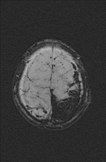 File:Bilateral subdural hemorrhage and parietal skull fracture (Radiopaedia 26058-26190 Axial SWI 72).png