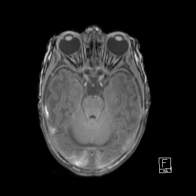 File:Bilateral subdural hemorrhage and parietal skull fracture (Radiopaedia 26058-26190 Axial T1 17).png