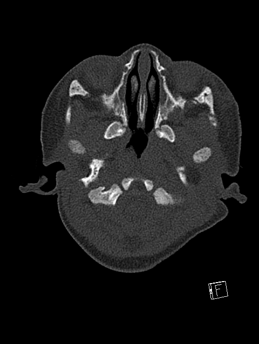 Bilateral subdural hemorrhage and parietal skull fracture (Radiopaedia 26058-26192 Axial bone window 118).png