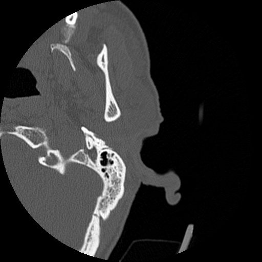 File:Bilateral temporal bone fractures (Radiopaedia 29482-29970 D 9).jpg