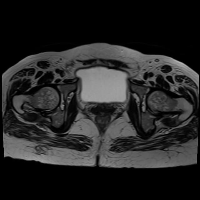 Bilateral tubo-ovarian abscesses (Radiopaedia 58635-65829 Axial T2 37).jpg