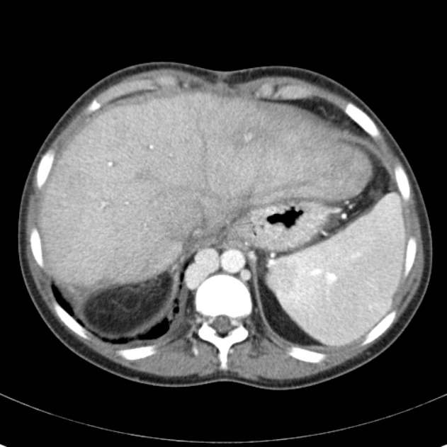 Biliary necrosis - liver transplant (Radiopaedia 21876-21846 B 12).jpg