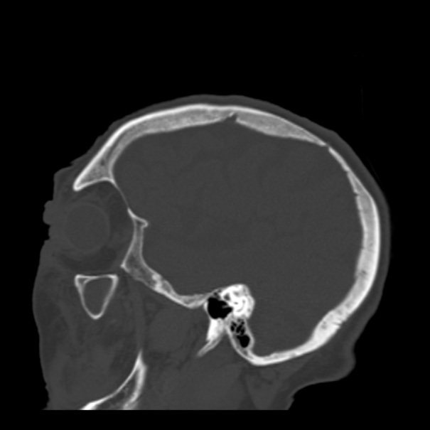 Biparietal osteodystrophy (Radiopaedia 46109-50463 Sagittal bone window 82).jpg