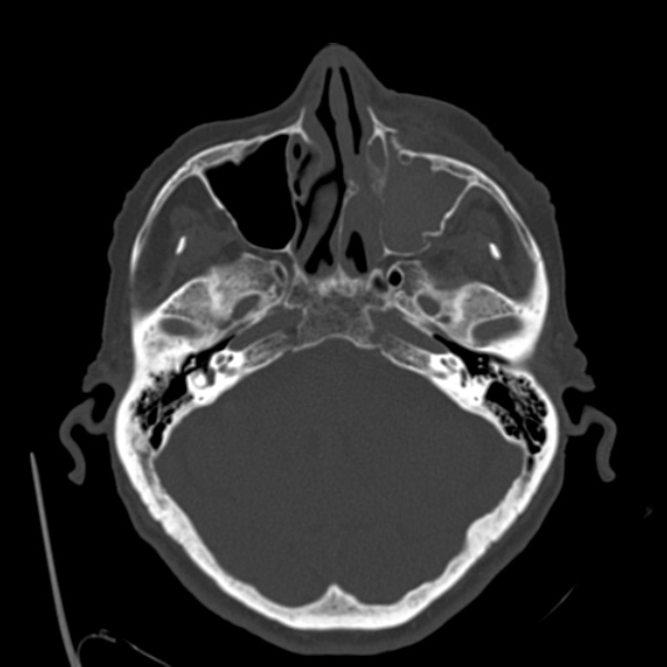 Biparietal osteodystrophy (Radiopaedia 46109-50463 bone window 19).jpg