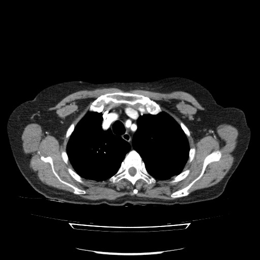 File:Bladder tumor detected on trauma CT (Radiopaedia 51809-57609 A 24).jpg