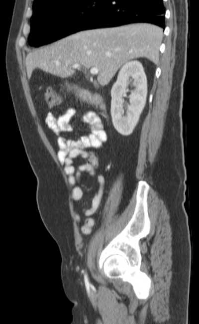Bleeding duodenal ulcer and adenomyomatosis of gallbladder (Radiopaedia 61834-69861 C 30).jpg