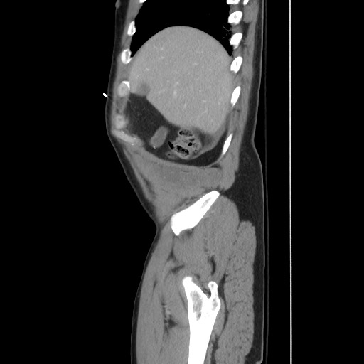 File:Blunt abdominal trauma with solid organ and musculoskelatal injury with active extravasation (Radiopaedia 68364-77895 C 32).jpg