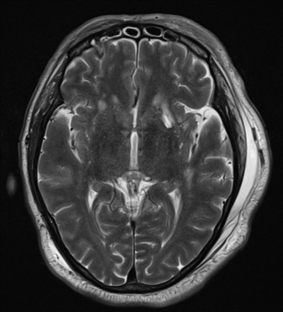 File:Blunt cerebrovascular injury (Radiopaedia 53682-59745 Axial T2 15).png
