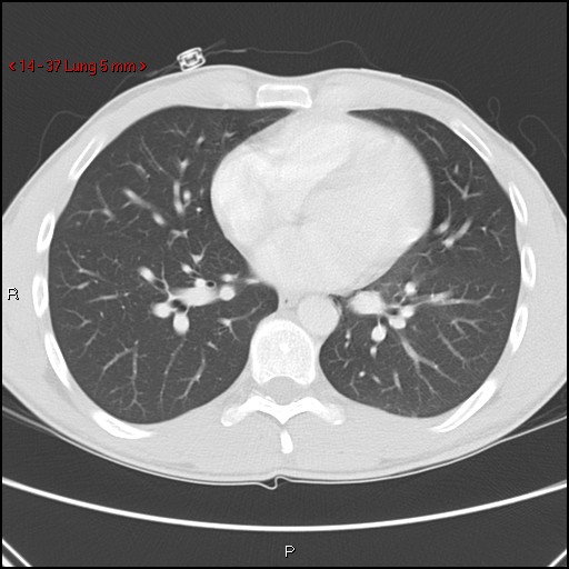 Blunt chest trauma - pulmonary interstitial emphysema and pneumomediastinum (Radiopaedia 20666-20552 Axial lung window 37).jpg