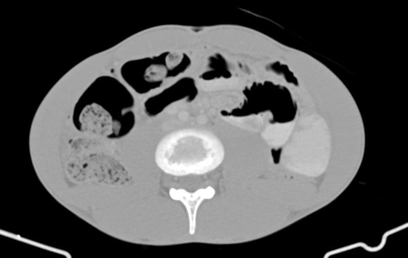Blunt injury to the small bowel (Radiopaedia 74953-85987 Axial Wide 53).jpg