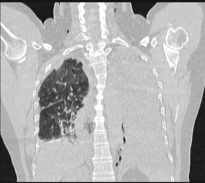 Boerhaave syndrome (Radiopaedia 45644-49799 Coronal lung window 48).jpg