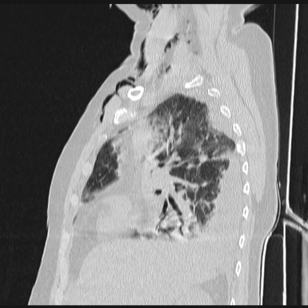 Boerhaave syndrome (Radiopaedia 45644-49799 Sagittal lung window 26).jpg