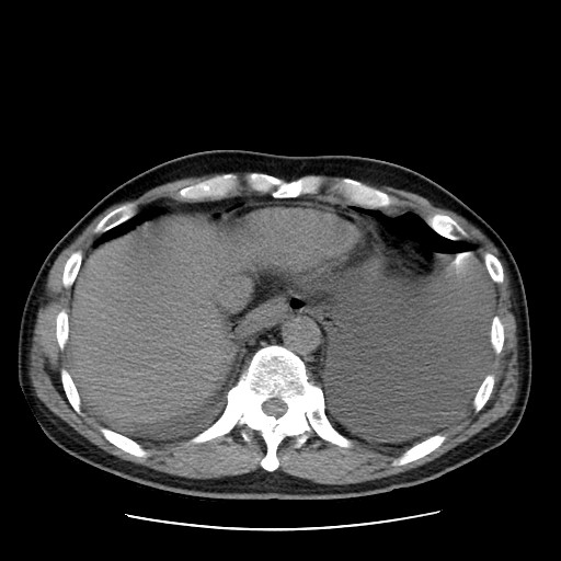 Boerhaave syndrome (Radiopaedia 59796-67310 Axial liver window 51).jpg