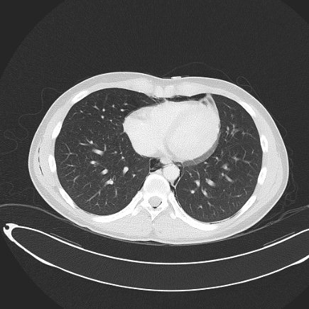 File:Boerhaave syndrome with mediastinal, axillary, neck and epidural free gas (Radiopaedia 41297-44115 Axial lung window 63).jpg