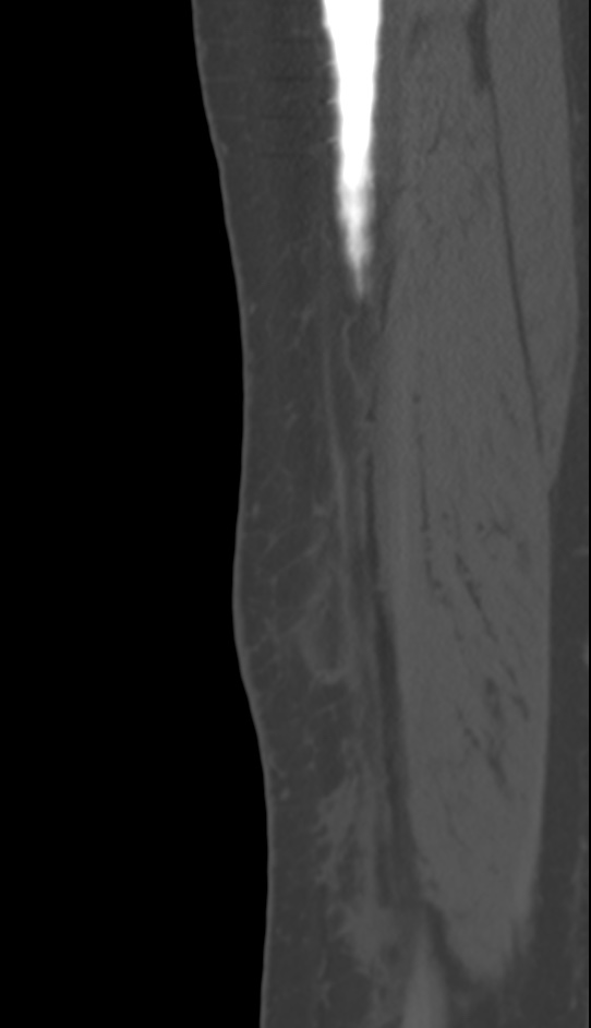 Bone metastasis - tibia (Radiopaedia 57665-64609 Sagittal bone window 29).jpg