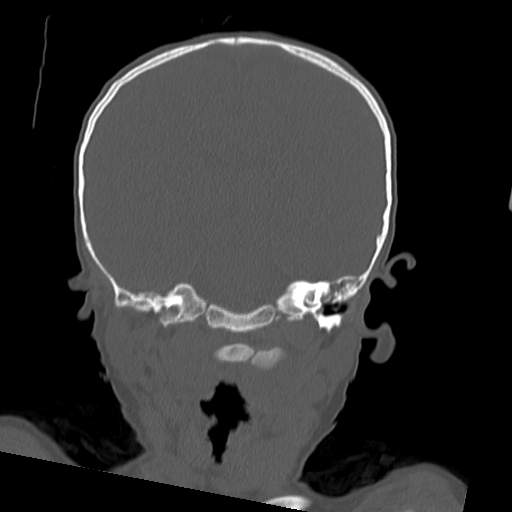 File:Bony atresia of the right external auditory canal (Radiopaedia 27916-28156 Coronal bone window 12).jpg