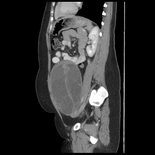 File:Borderline mucinous tumor (ovary) (Radiopaedia 78228-90808 B 44).jpg