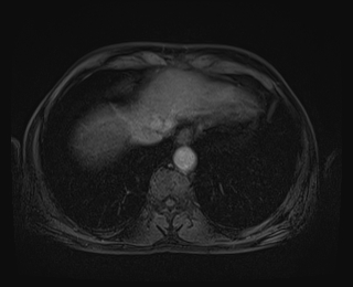 File:Bouveret syndrome (Radiopaedia 61017-68856 Axial T1 C+ fat sat 7).jpg