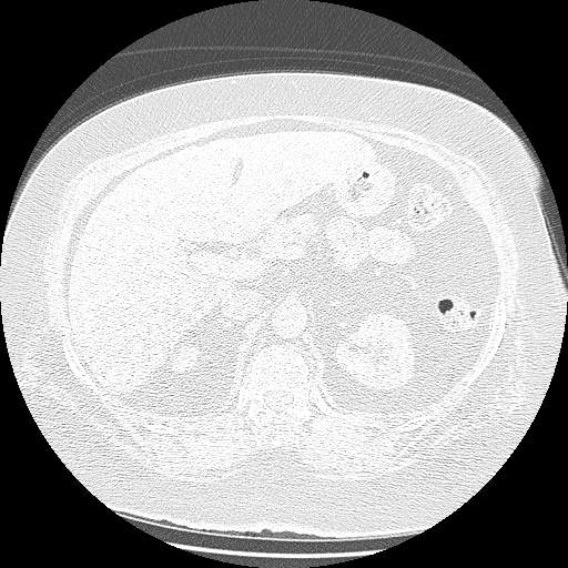 Bovine aortic arch - right internal mammary vein drains into the superior vena cava (Radiopaedia 63296-71875 Axial lung window 195).jpg
