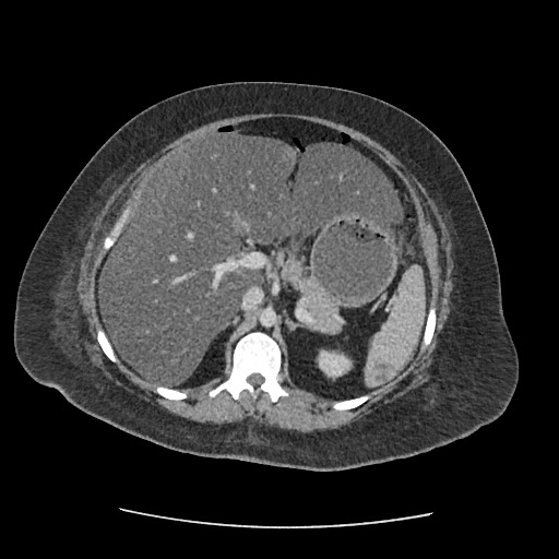Bowel and splenic infarcts in acute lymphocytic leukemia (Radiopaedia 61055-68915 A 48).jpg