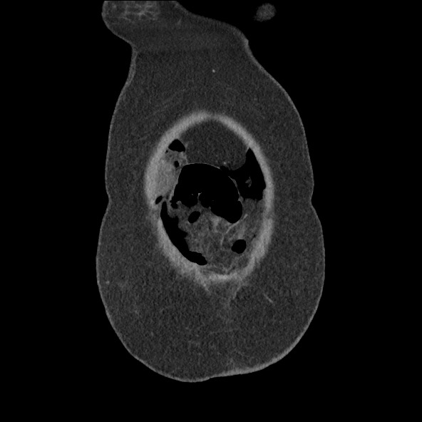Bowel and splenic infarcts in acute lymphocytic leukemia (Radiopaedia 61055-68915 B 9).jpg