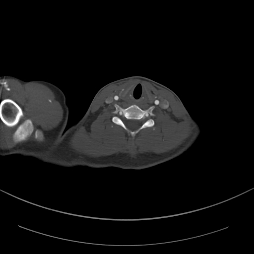 Brachiocephalic trunk pseudoaneurysm (Radiopaedia 70978-81191 Axial bone window 29).jpg