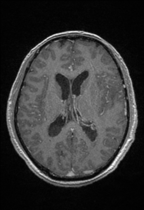Brain abscess with ventriculitis (Radiopaedia 85703-101495 Axial T1 C+ 103).jpg