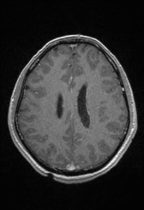 Brain abscess with ventriculitis (Radiopaedia 85703-101495 Axial T1 C+ 118).jpg