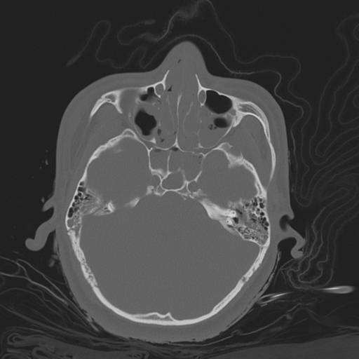 File:Brain contusions, internal carotid artery dissection and base of skull fracture (Radiopaedia 34089-35339 Axial bone window 58).png