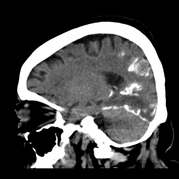 Brain cortical laminar necrosis (Radiopaedia 25822-25971 non-contrast 33).jpg