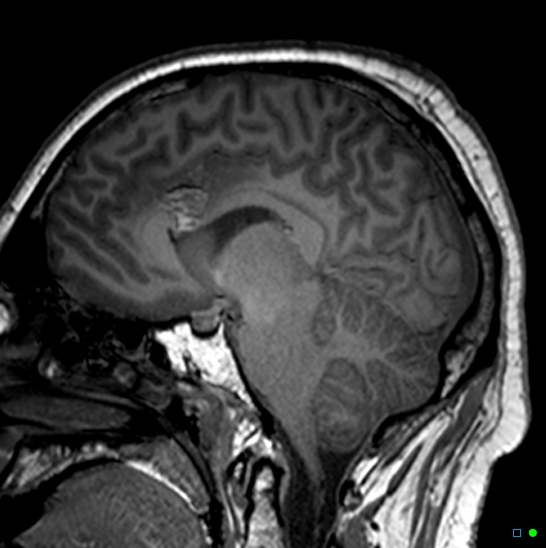 Brain death on MRI and CT angiography (Radiopaedia 42560-45689 Sagittal T1 19).jpg