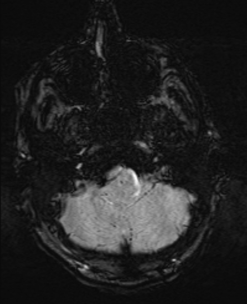 Brain metastases - lung cancer primary (Radiopaedia 75060-86115 Axial SWI 11).jpg