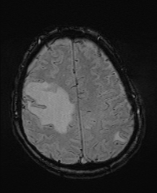 Brain metastases - lung cancer primary (Radiopaedia 75060-86115 Axial SWI 46).jpg