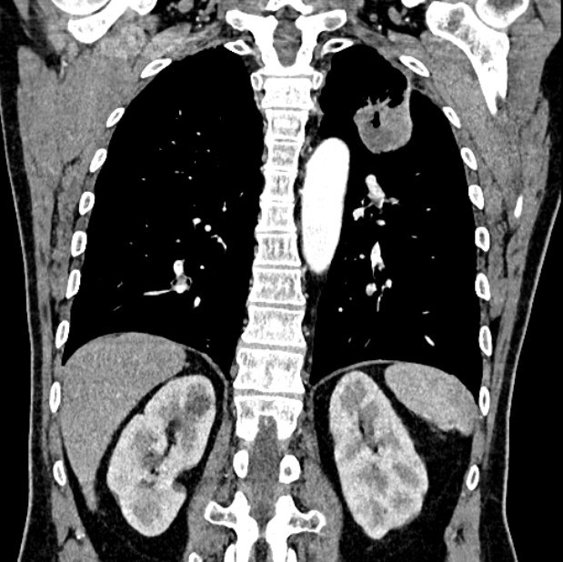 Brain metastases - lung cancer primary (Radiopaedia 75060-86116 C+ arterial phase 48).jpg