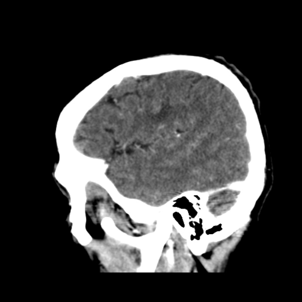 Brain metastases from lung cancer (Radiopaedia 24480-24781 C+ delayed 12).jpg