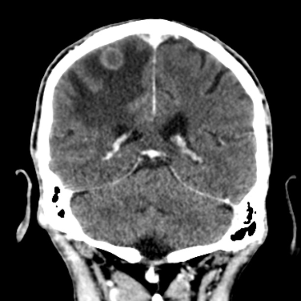 Brain metastases from lung cancer (Radiopaedia 27849-28092 Coronal C+ delayed 45).jpg