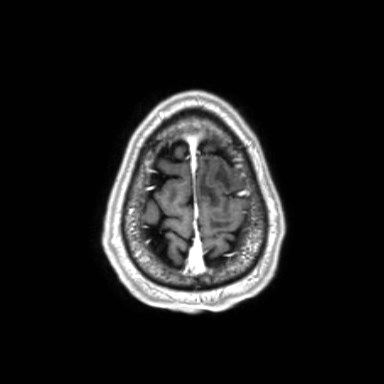 Brain metastases from lung cancer (Radiopaedia 83839-99028 Axial T1 C+ 63).jpg