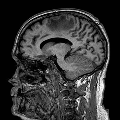 Brain metastases from lung cancer (Radiopaedia 83839-99028 Sagittal T1 75).jpg