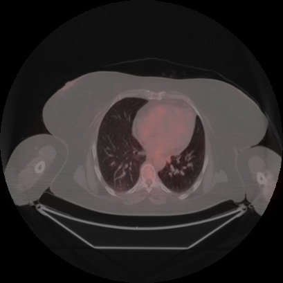 Brain metastasis (Radiopaedia 89847-106962 Axial lung window 38).jpg