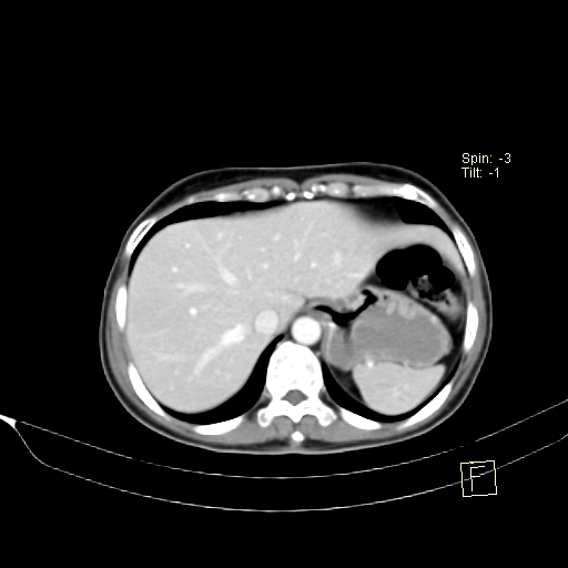 Brain metastasis as initial presentation of non-small cell lung cancer (Radiopaedia 65122-74127 A 42).jpg