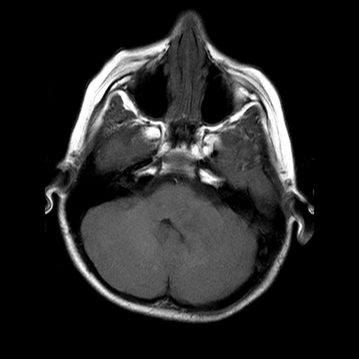 File:Brainstem ganglioglioma (Radiopaedia 10763-11224 Axial T1 15).jpg