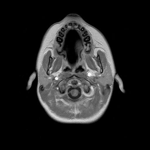 File:Brainstem ganglioglioma (Radiopaedia 10763-11224 Axial T1 C+ 16).jpg