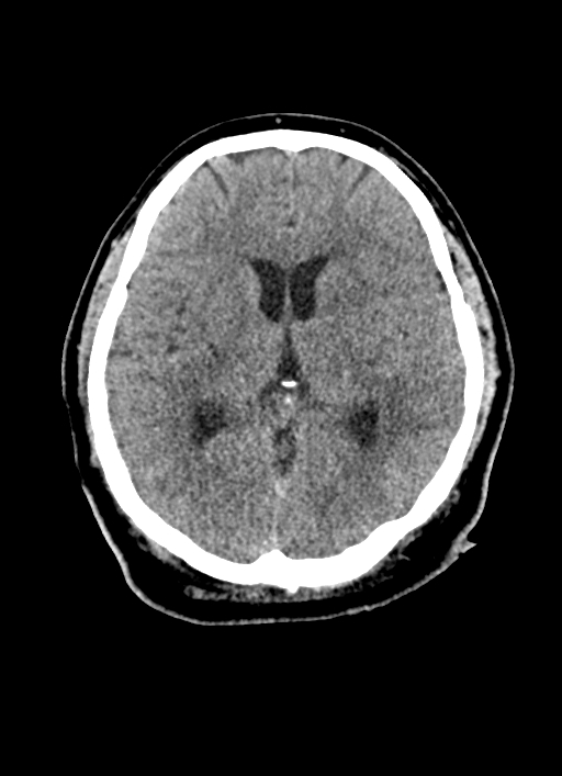 Brainstem hemorrhage (Radiopaedia 81294-94976 Axial non-contrast 32).jpg