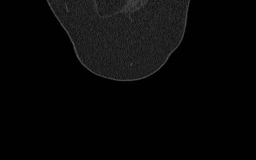 Breast carcinoma with pathological hip fracture (Radiopaedia 60314-67993 Coronal bone window 22).jpg