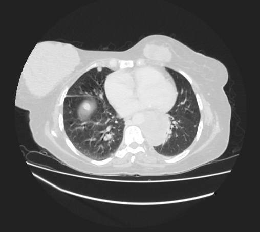 Breast metastases from facial malignant melanoma (Radiopaedia 60316-67975 Axial lung window 71).jpg