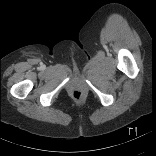 File:Breast metastases from renal cell cancer (Radiopaedia 79220-92225 C 130).jpg